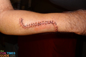 As a reference point, this is what Jim's arm looked like 3 days after ...
