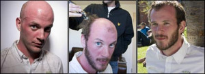 Robert bald; having hair plugs implanted; and with a full head of fake ...