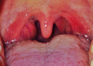 Swollen Tonsil On One Side