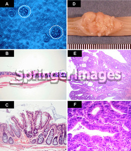 Macroscopic and microscopic pictures of ACF and colon cancer in rats ...