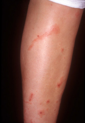 Itchy Rash Inner Thigh Only
