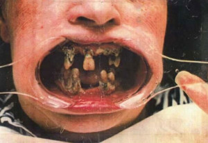 Pictures of really bad teeth pictures 4