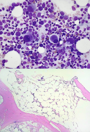 aplastic anemia bone marrow