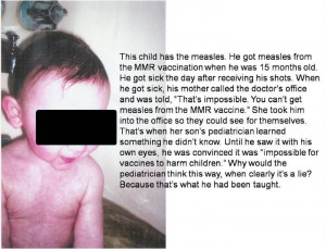 measles from the #MMR #vaccine #VAERS #vaccineinjury #vaccinefailure