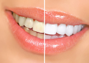 Cosmetic Dentistry – Teeth Whitening