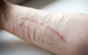 Self-Harm Motivated by Various Types of Bullying
