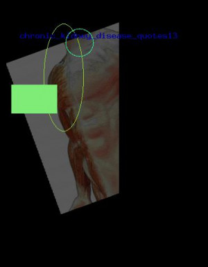 chronic kidney disease quotes