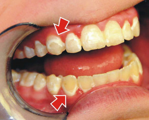 User Comments on - Why Are Teeth Stained After Braces Removal