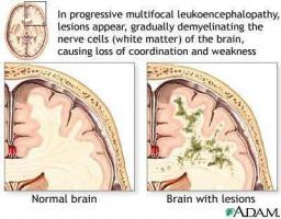 Progressive Multifocal Leukoencephalopathy (PML)