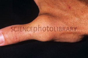 photo library caption model released swollen thumb swollen base