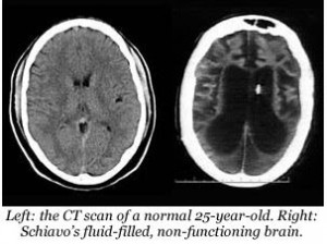 Terri Schiavo Brain Scan Ct Scan Of The Brain Of