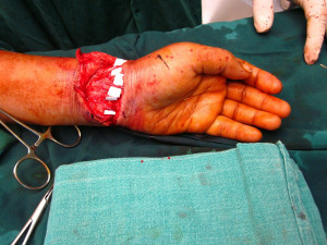 ... -young-female-cut-both-her-wrists-wrist-20cutter-20-283-29.jpg