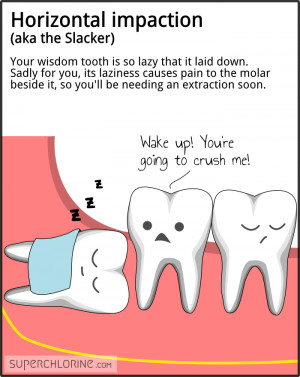 Horizontal impaction (aka the Slacker). Your wisdom tooth is so lazy ...