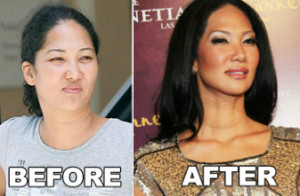 Kimora Lee Simmons Nose Job before and after photo