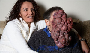 10 People With Shocking and Extreme Deformities