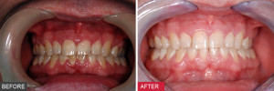 mild periodontitis periodontitis gum disease