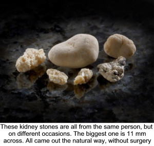 These kidney stones are all from the same person, but on different ...