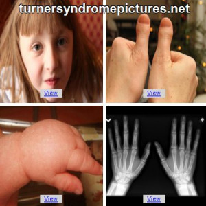 Turner Syndrome Wikipedia...