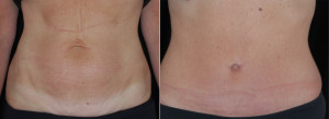 Before and After Photo of Full Tummy Tuck Front View showing Inny ...