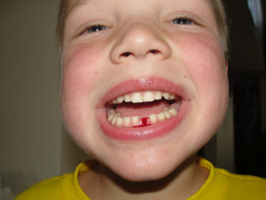 Finally lost my first tooth!