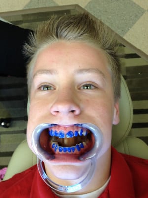 Alex got his braces! Just what he wanted for Christmas.