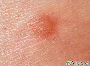 chigger bites bed bug bites al