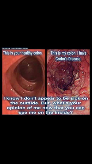 What Crohn's disease looks like...don't ever tell someone that they ...