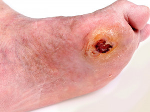 Symptoms of Diabetic Foot Ulcers