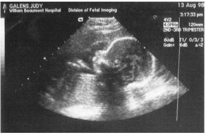 Related Pictures an ultrasound picture is the first glimpse of your ...