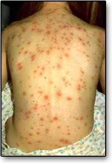 Related to What Is Disseminated Herpes Zoster With Pictures