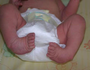 Support for Parents of Clubfoot Children