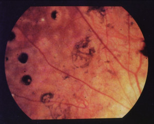 Congenital Syphilis