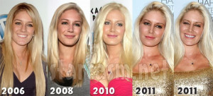 Heidi Montag Plastic Surgery Before and After Breast Implants Pictures