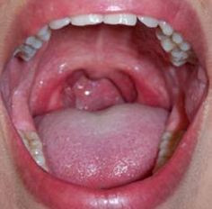 Symptoms of Throat Cancer - Having a Chronic Sore Throat?