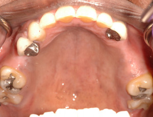 Upper Partial Dentures for Back Teeth