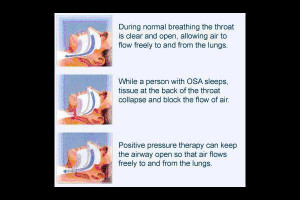 Sleep apnea Wallpaper