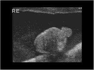 Appendix Testis Ultrasound
