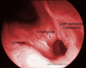 Internal Nasal Valve