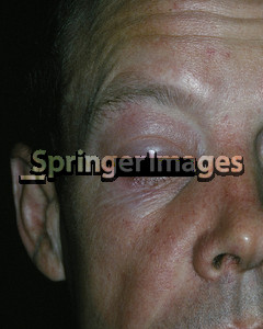 Angioedema affecting the right upper eyelid and, to a lesser extent ...