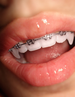 braces, lips, nice teeth, vamp