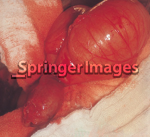 Acute appendicitis without gangrene or perforation