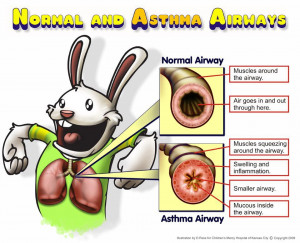 Asthma Treatment And Causes