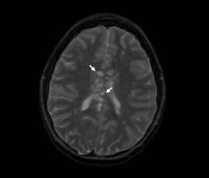 brain mri showing ms lesions