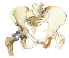 Hip Revision Joint Replacement