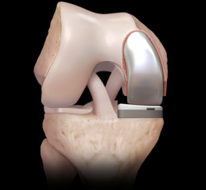 Partial knee replacement 0 large