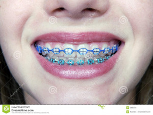 Royalty Free Stock Photo: Pretty Smile with Braces
