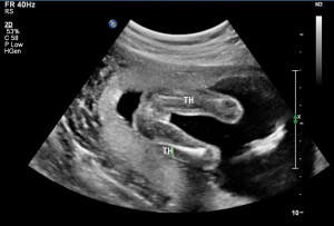 week ultrasound scan boy girl gender