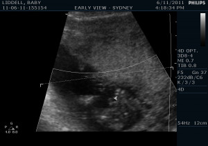 Had ultrasound at 15 weeks 4 days technician thinks girl how accurate