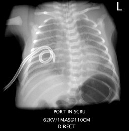 Pigtail Chest Tube Pneumothorax