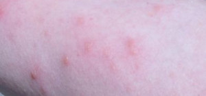 Poison Ivy Rash Pictures Symptoms Causes Treatment